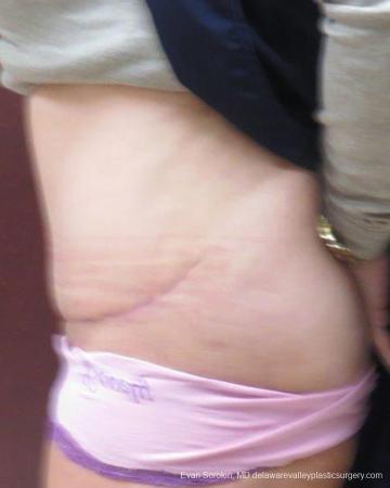Philadelphia Abdominoplasty 9267 - After Image 5