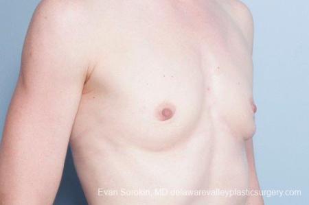 Philadelphia Breast Augmentation 9169 - Before Image 2