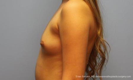 Philadelphia Breast Augmentation 9194 - Before and After Image 5