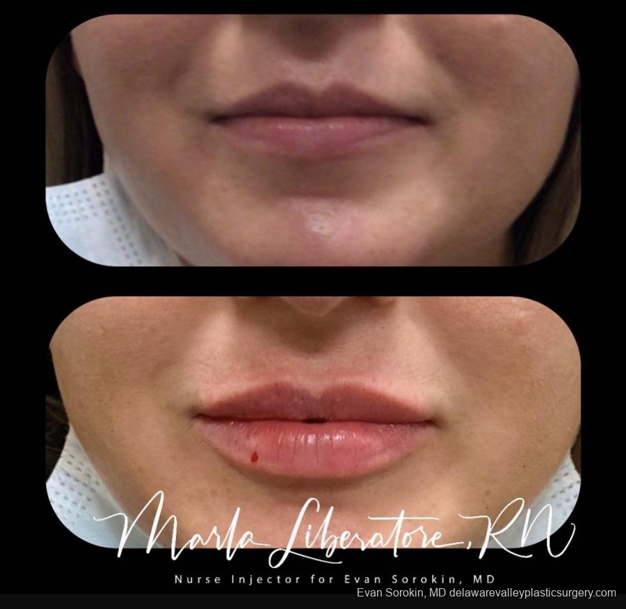 Lip Augmentation: Patient 22 - Before and After Image 1