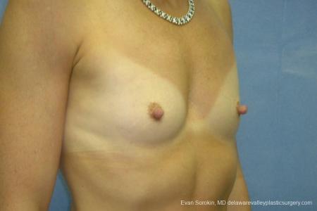 Breast Augmentation 8667 - Before Image 2