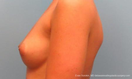 Breast Augmentation: Patient 11 - Before and After Image 5