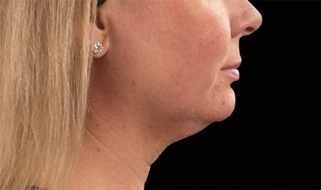 CoolSculpting®: Patient 5 - Before Image 1