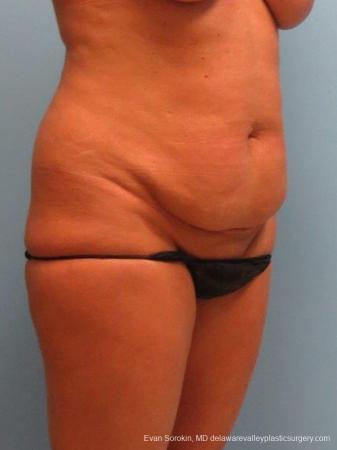 Philadelphia Abdominoplasty 9463 - Before Image 2