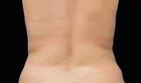 CoolSculpting®: Patient 14 - After Image 1