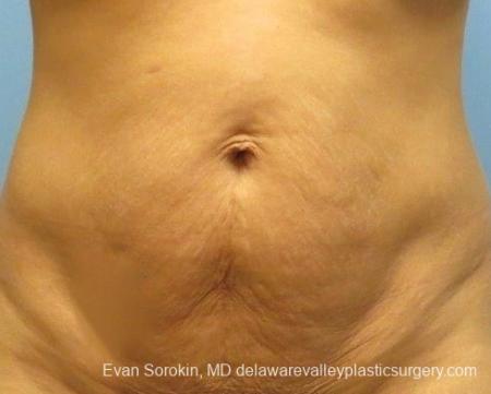 Philadelphia Abdominoplasty 8825 - Before Image 1