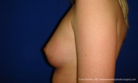 Philadelphia Breast Augmentation 9293 - Before and After Image 5