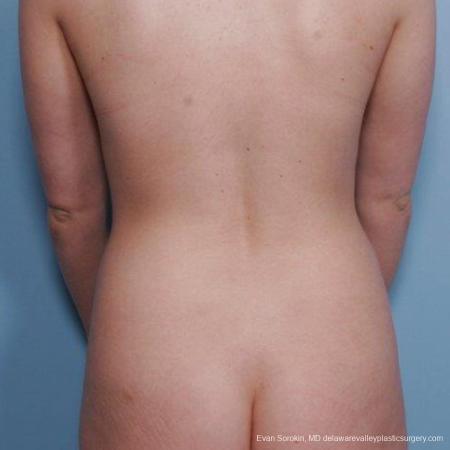Philadelphia Liposuction 9482 - Before and After Image 5