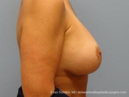 Philadelphia Breast Lift and Augmentation 8696 - After Image 4