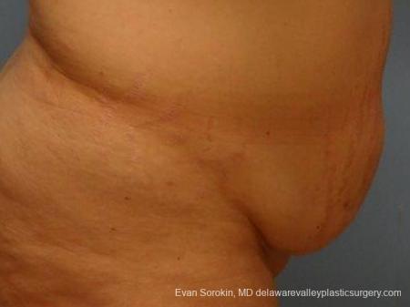 Philadelphia Abdominoplasty 9467 - Before Image 3