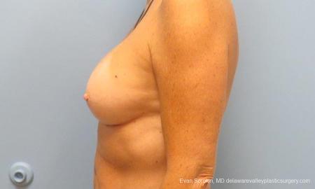 Philadelphia Breast Augmentation 9549 - After Image 5
