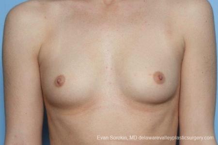 Philadelphia Breast Augmentation 8771 - Before Image 1