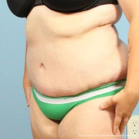 Philadelphia Abdominoplasty 9466 - After Image 3