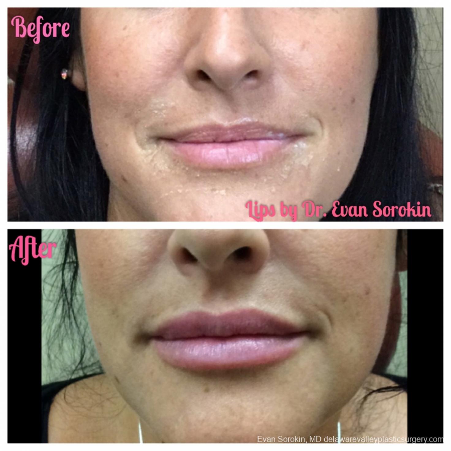 Lip Augmentation: Patient 38 - Before and After 1