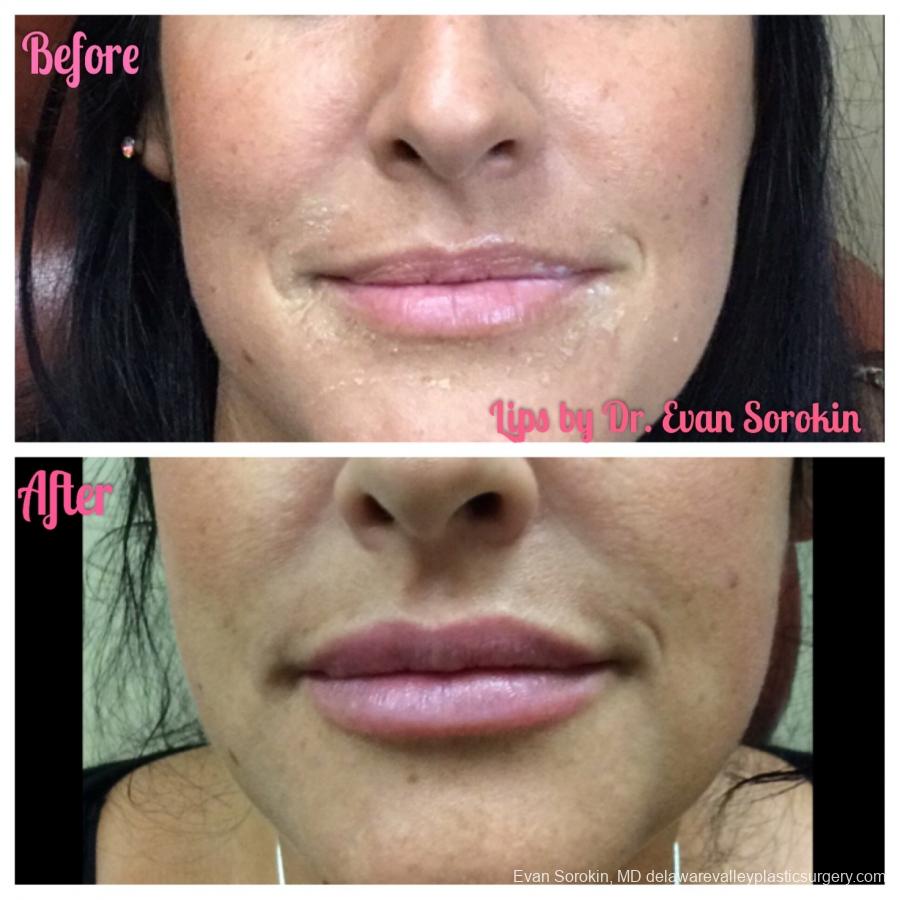 Lip Augmentation: Patient 3 - Before and After Image 1