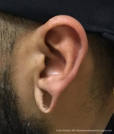 Philadelphia Earlobe Surgery 13181 - Before Image 1