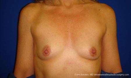Philadelphia Breast Augmentation 9412 - Before Image 1