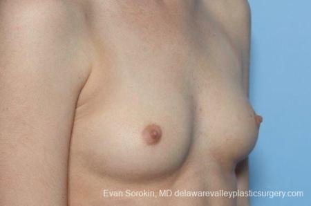 Philadelphia Breast Augmentation 8771 - Before Image 2