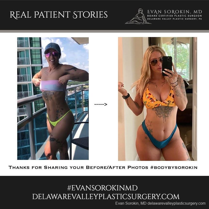 Real Patient Stories: Patient 3 - Before and After 1