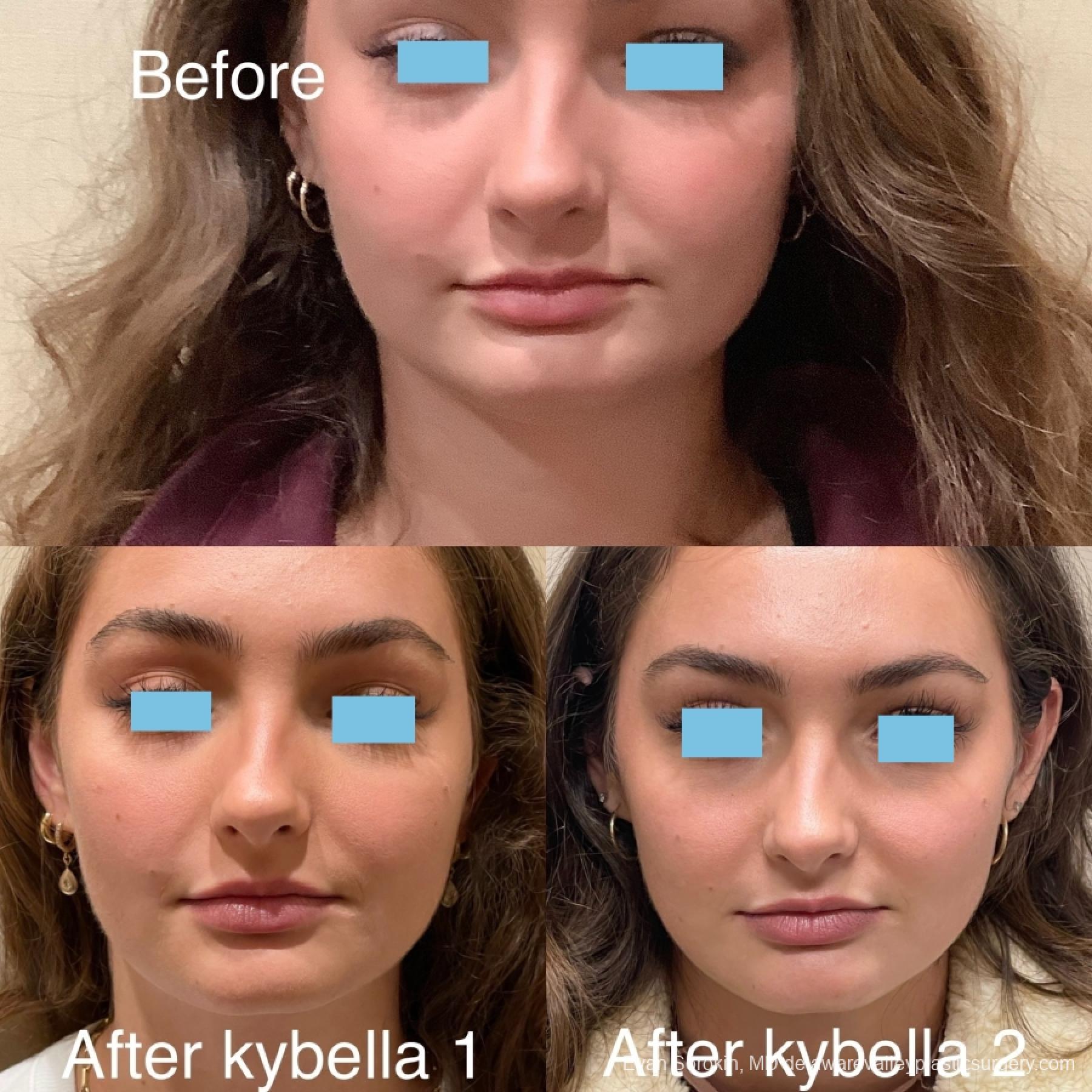 Fillers: Patient 43 - Before and After 1