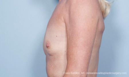Philadelphia Breast Augmentation 9415 - Before and After Image 5