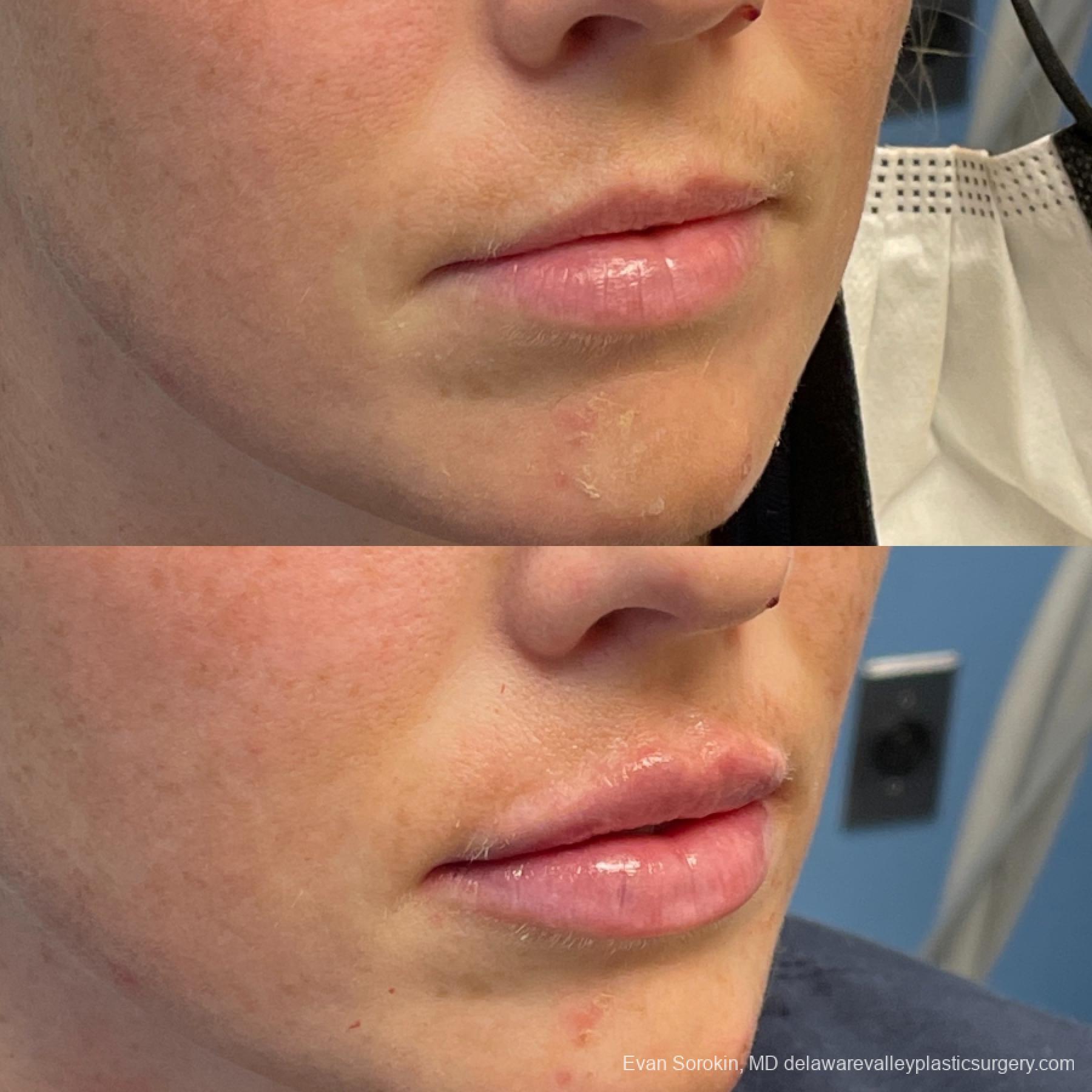 Fillers: Patient 27 - Before and After 2