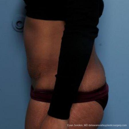 Philadelphia Abdominoplasty 9479 - After Image 5