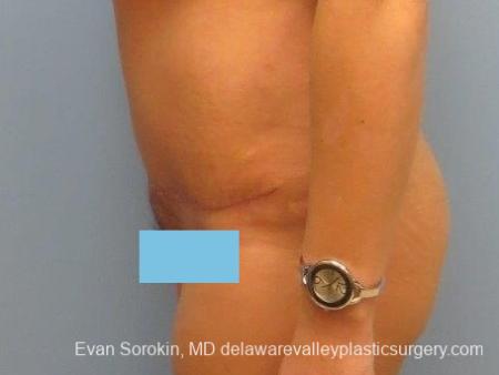 Philadelphia Abdominoplasty 8672 - After Image 4