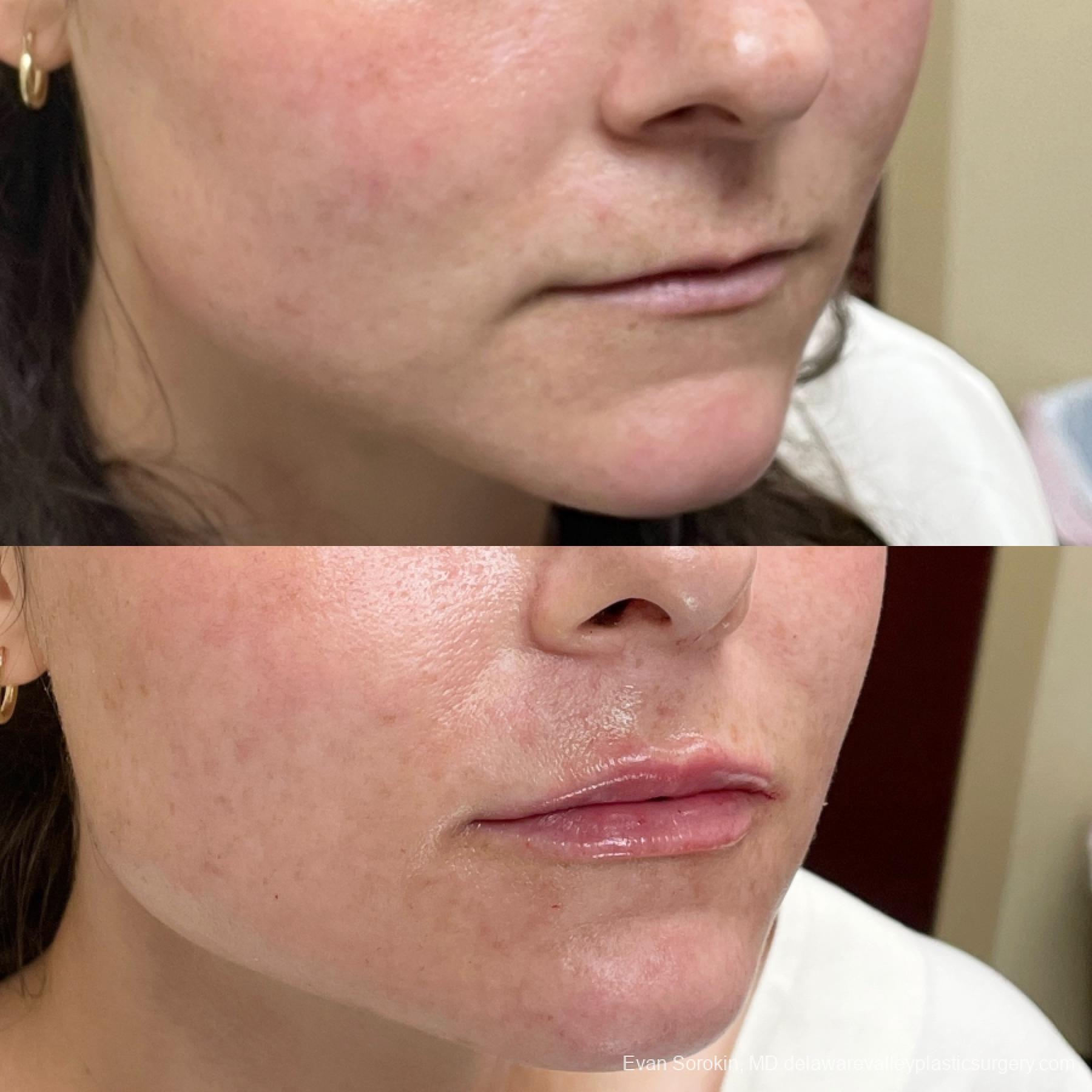 Lip Filler: Patient 28 - Before and After 2
