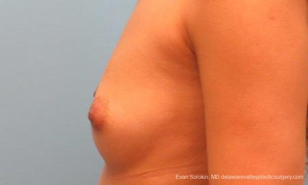 Philadelphia Breast Augmentation 9341 - Before and After Image 5