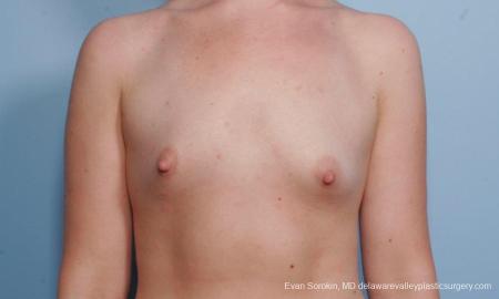 Philadelphia Breast Augmentation 9176 - Before Image 1