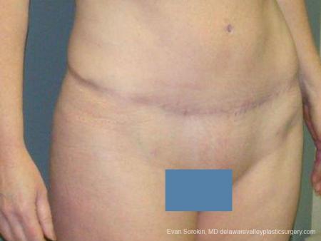 Philadelphia Abdominoplasty 9474 - After Image 2