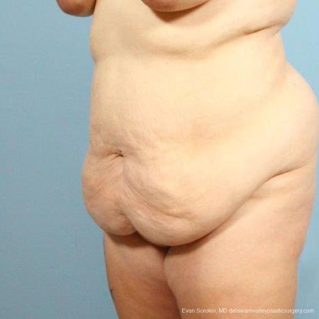 Philadelphia Abdominoplasty 9466 - Before Image 3