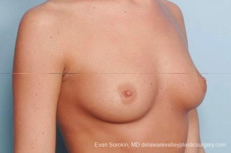 Philadelphia Breast Augmentation 8792 - Before Image 2