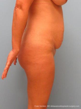 Philadelphia Abdominoplasty 9460 - Before Image 3
