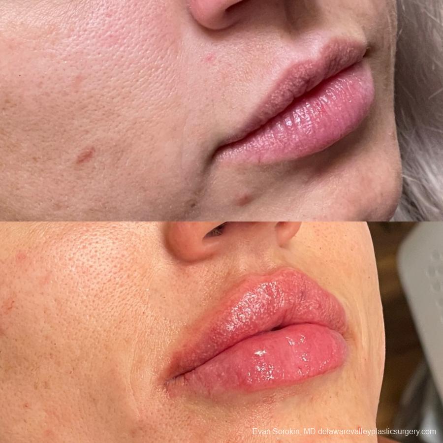 Lip Filler: Patient 59 - Before and After 2