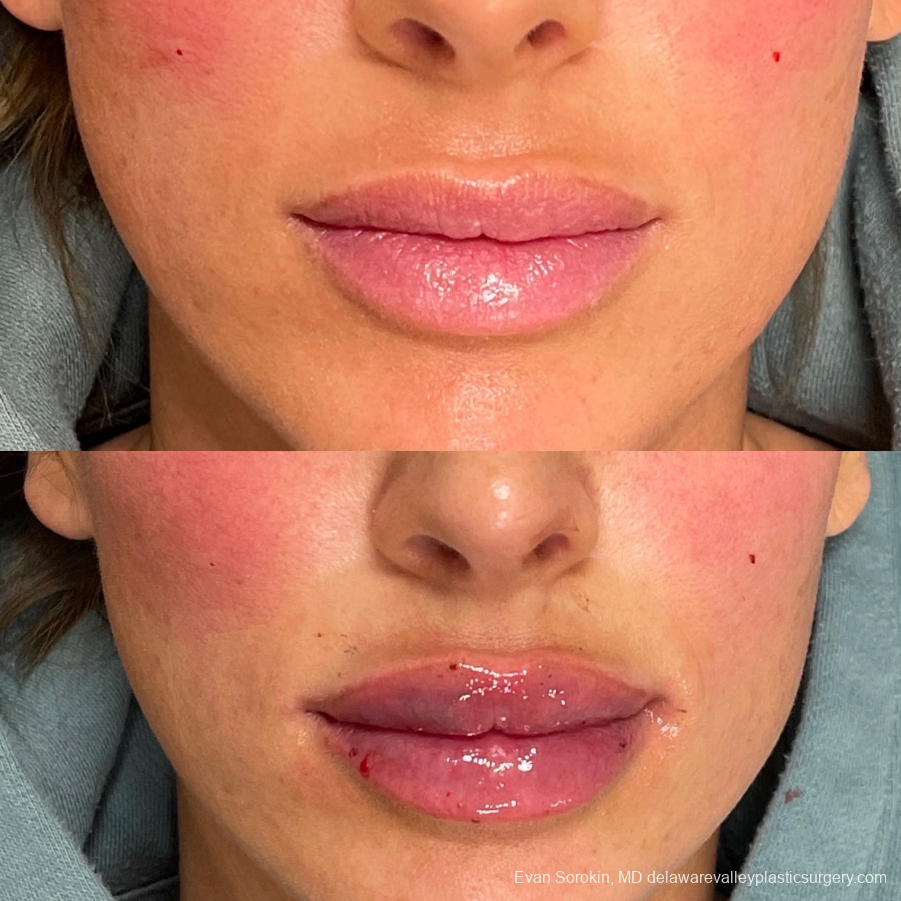 Fillers: Patient 37 - Before and After 1