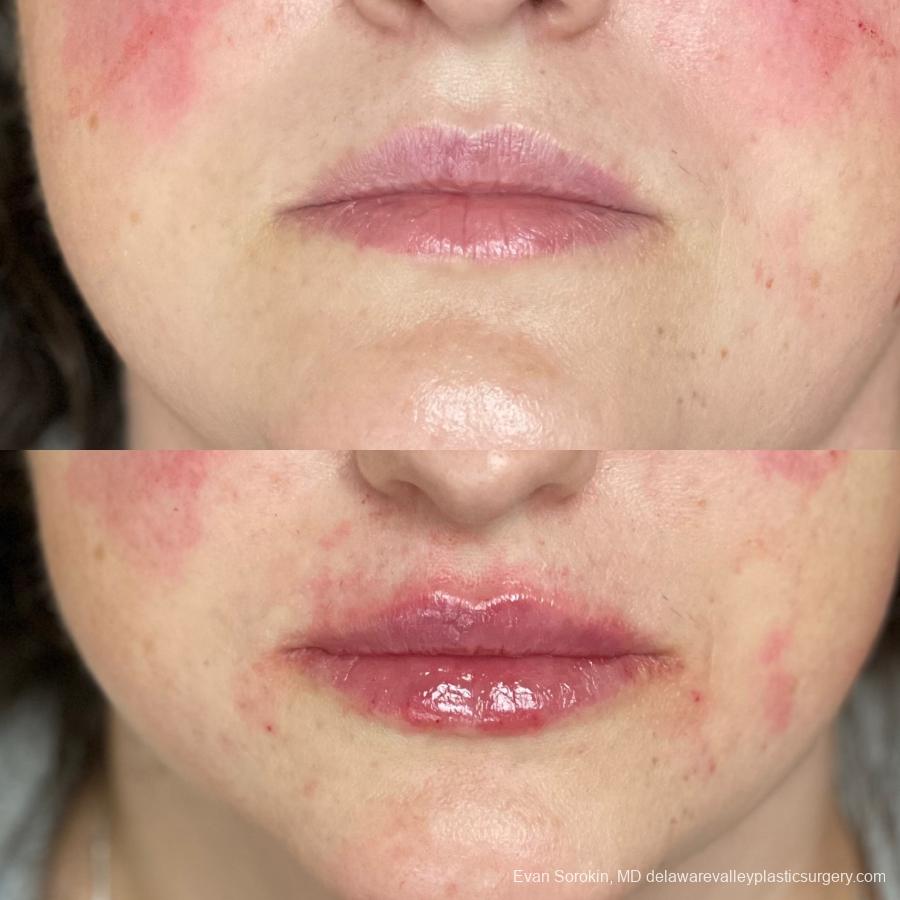 Lip Augmentation: Patient 8 - Before and After  