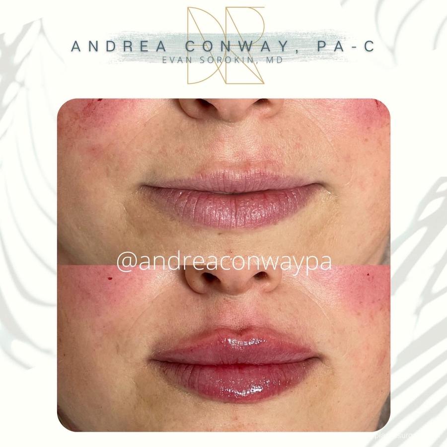Lip Filler: Patient 15 - Before and After 1