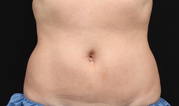 CoolSculpting®: Patient 2 - After  