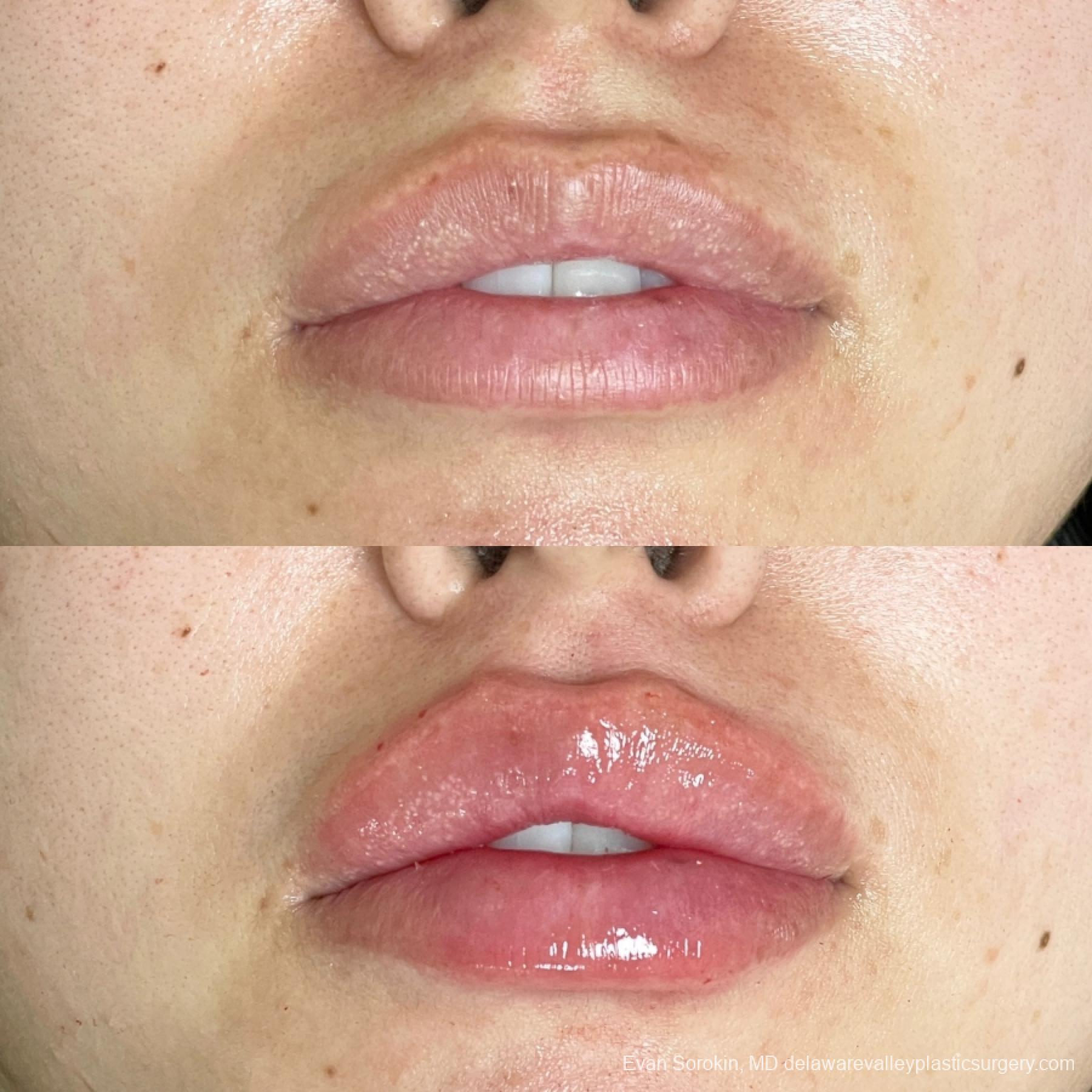 Fillers: Patient 6 - Before and After  