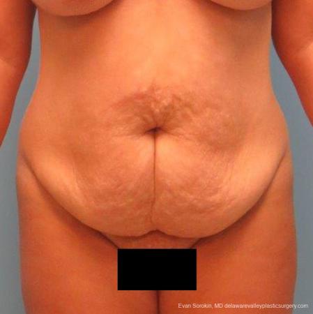 Philadelphia Abdominoplasty 9267 - Before Image 1