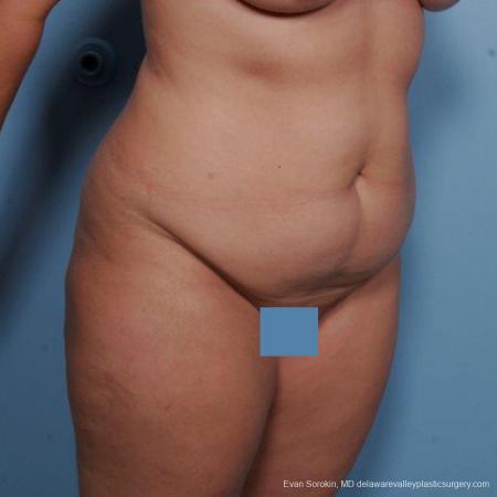Philadelphia Liposuction 9481 - Before Image 2
