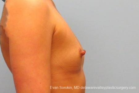 Philadelphia Breast Augmentation 9410 - Before Image 3
