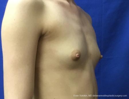 Breast Augmentation: Patient 160 - Before and After Image 2