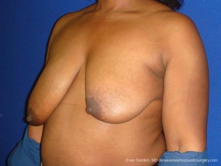 Philadelphia Breast Lift and Augmentation 8684 - Before Image 3