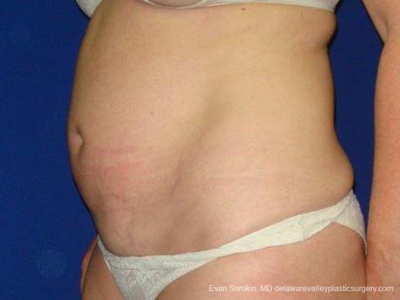 Philadelphia Abdominoplasty 9474 - Before and After Image 5