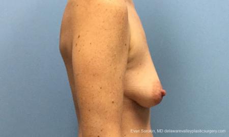 Philadelphia Breast Lift and Augmentation 10814 - Before Image 3