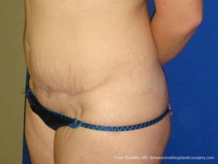 Philadelphia Abdominoplasty 9473 - After Image 4
