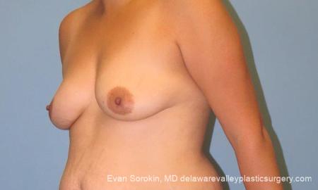 Philadelphia Breast Lift and Augmentation 10123 - Before Image 4